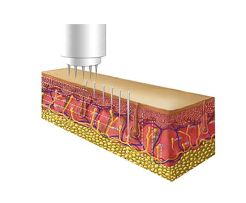 ¿Conoces la Micropuncion Estetica? Imagen detalle piel micropuncion