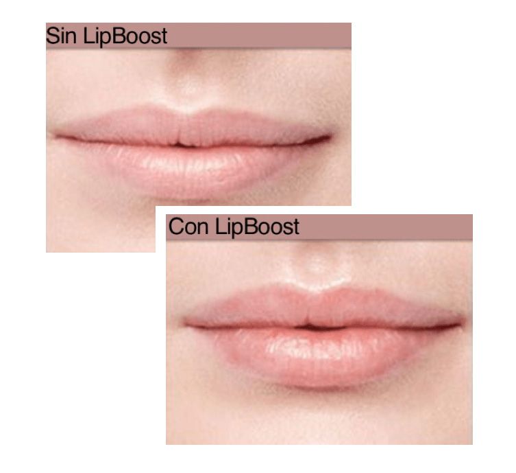 ¿Conoces la Micropunción Estética? LipBoost